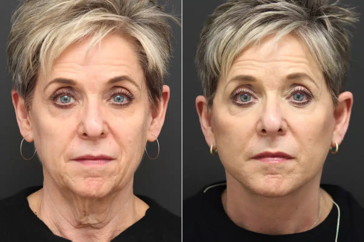 Facelift Before and After Photos in Princeton, NJ, Patient 10055