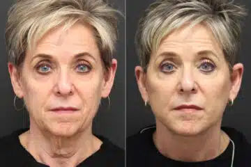 Facelift Before and After Photos in Princeton, NJ, Patient 10055