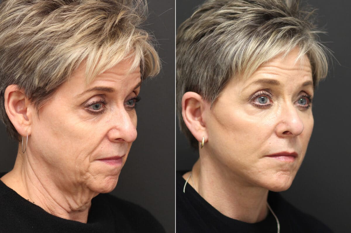 Facelift Before and After Photos in Princeton, NJ, Patient 10055