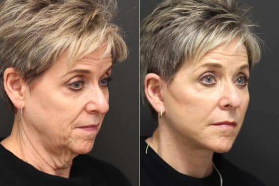 Facelift Before and After Photos in Princeton, NJ, Patient 10055