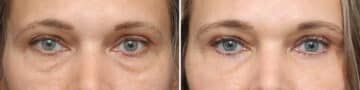 Lower Eyelid Surgery Before and After Photos in Princeton, NJ, Patient 10856