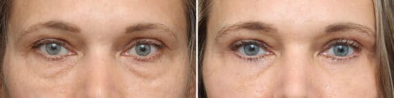 Lower Eyelid Surgery Before and After Photos in Princeton, NJ, Patient 10856