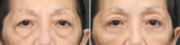 Lower Eyelid Surgery Before and After Photos in Princeton, NJ, Patient 10857