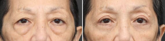 Lower Eyelid Surgery Before and After Photos in Princeton, NJ, Patient 10857