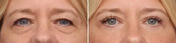 Lower Eyelid Surgery Before and After Photos in Princeton, NJ, Patient 10858