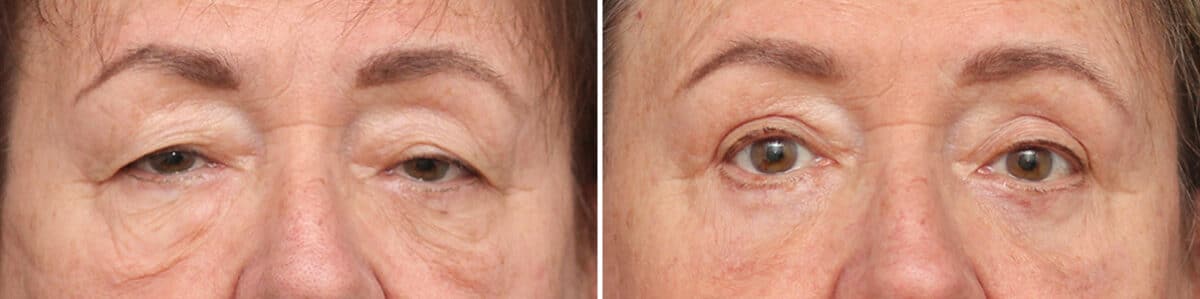 Lower Eyelid Surgery Before and After Photos in Princeton, NJ, Patient 10859