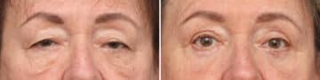 Lower Eyelid Surgery Before and After Photos in Princeton, NJ, Patient 10859