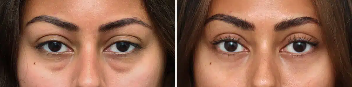 Lower Eyelid Surgery Before and After Photos in Princeton, NJ, Patient 10860