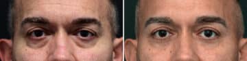 Lower Eyelid Surgery Before and After Photos in Princeton, NJ, Patient 10861