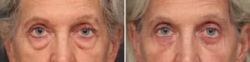 Lower Eyelid Surgery Before and After Photos in Princeton, NJ, Patient 10862