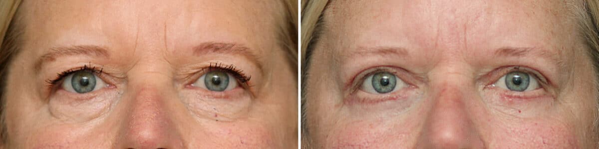 Lower Eyelid Surgery Before and After Photos in Princeton, NJ, Patient 10863