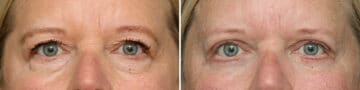 Lower Eyelid Surgery Before and After Photos in Princeton, NJ, Patient 10863