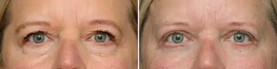 Lower Eyelid Surgery Before and After Photos in Princeton, NJ, Patient 10863