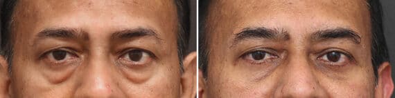 Lower Eyelid Surgery Before and After Photos in Princeton, NJ, Patient 10864