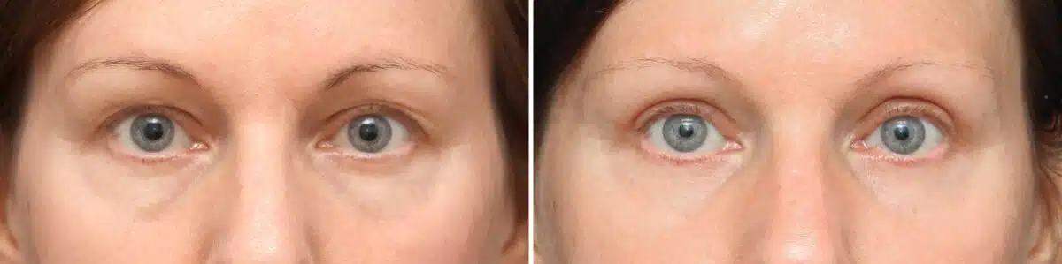 Upper Eyelid Surgery Before and After Photos in Princeton, NJ, Patient 10897