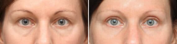 Upper Eyelid Surgery Before and After Photos in Princeton, NJ, Patient 10897