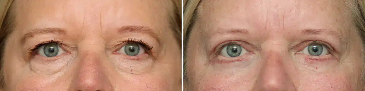 Upper Eyelid Surgery Before and After Photos in Princeton, NJ, Patient 10898