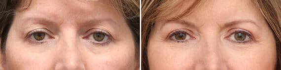 Upper Eyelid Surgery Before and After Photos in Princeton, NJ, Patient 10899