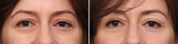 Upper Eyelid Surgery Before and After Photos in Princeton, NJ, Patient 10900