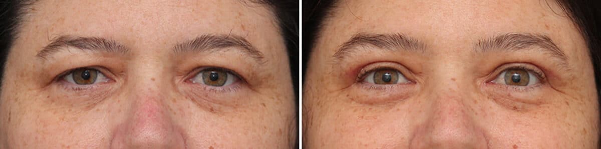 Upper Eyelid Surgery Before and After Photos in Princeton, NJ, Patient 10901