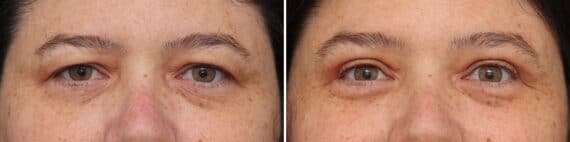 Upper Eyelid Surgery Before and After Photos in Princeton, NJ, Patient 10901