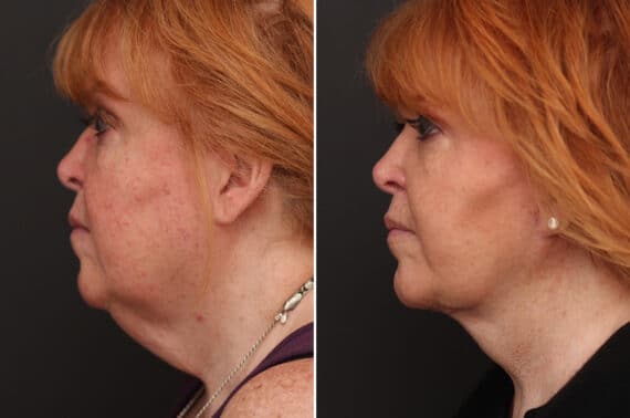 Facelift Before and After Photos in Princeton, NJ, Patient 10973