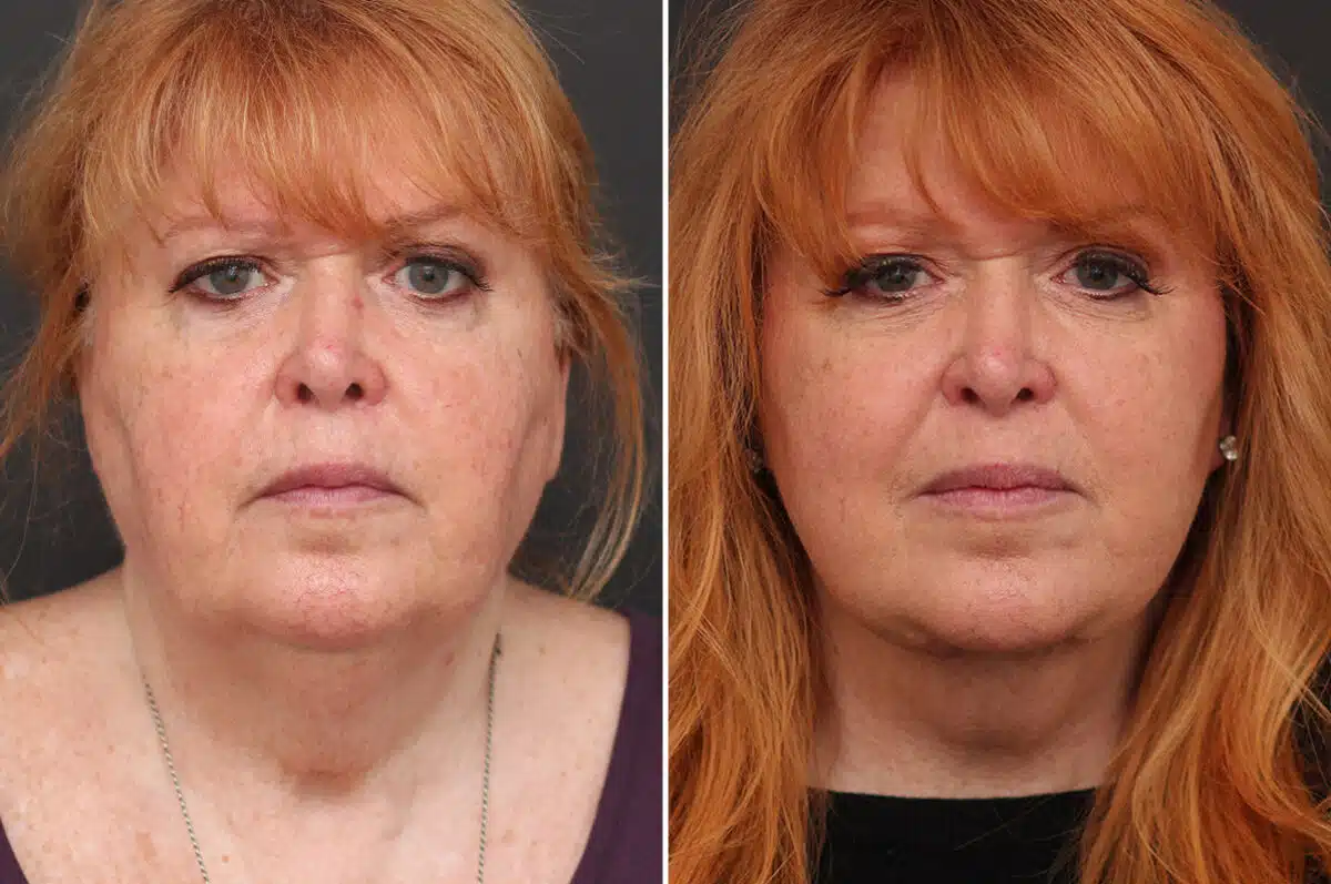 Facelift Before and After Photos in Princeton, NJ, Patient 10973