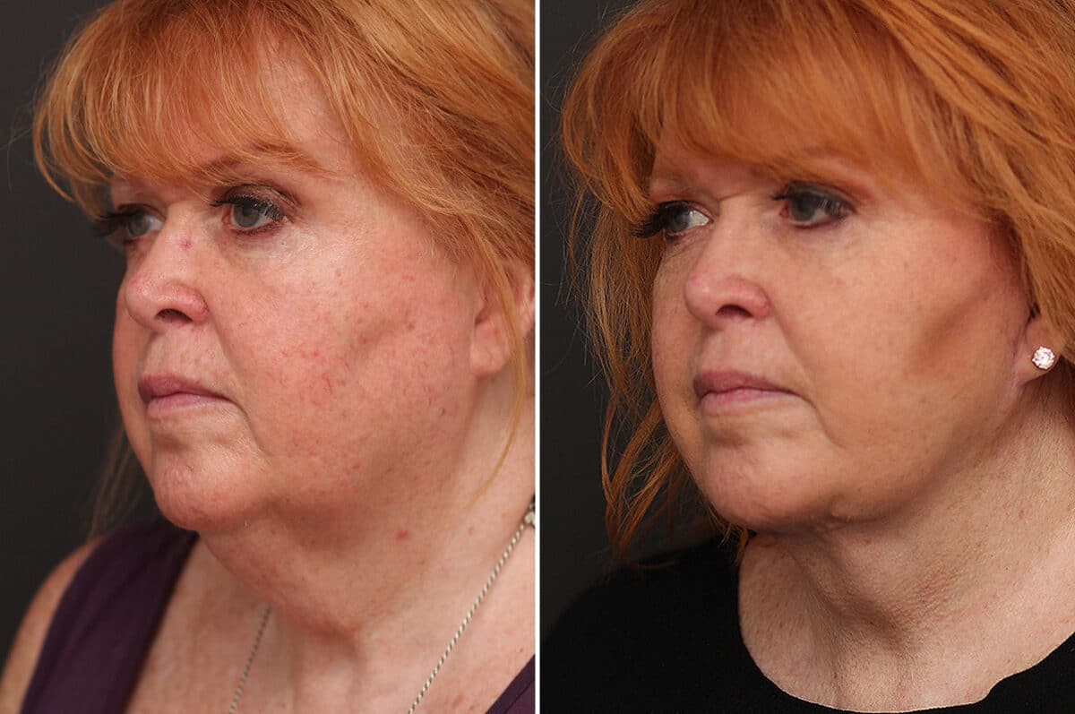 Facelift Before and After Photos in Princeton, NJ, Patient 10973