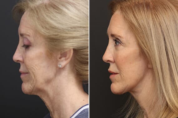 Facelift Before and After Photos in Princeton, NJ, Patient 10974