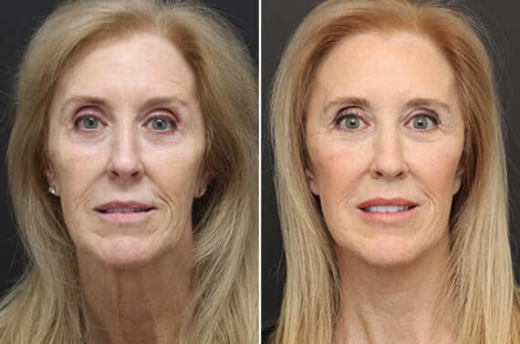 Facelift Before and After Photos in Princeton, NJ, Patient 10974