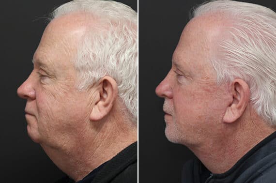 Facelift Before and After Photos in Princeton, NJ, Patient 10975