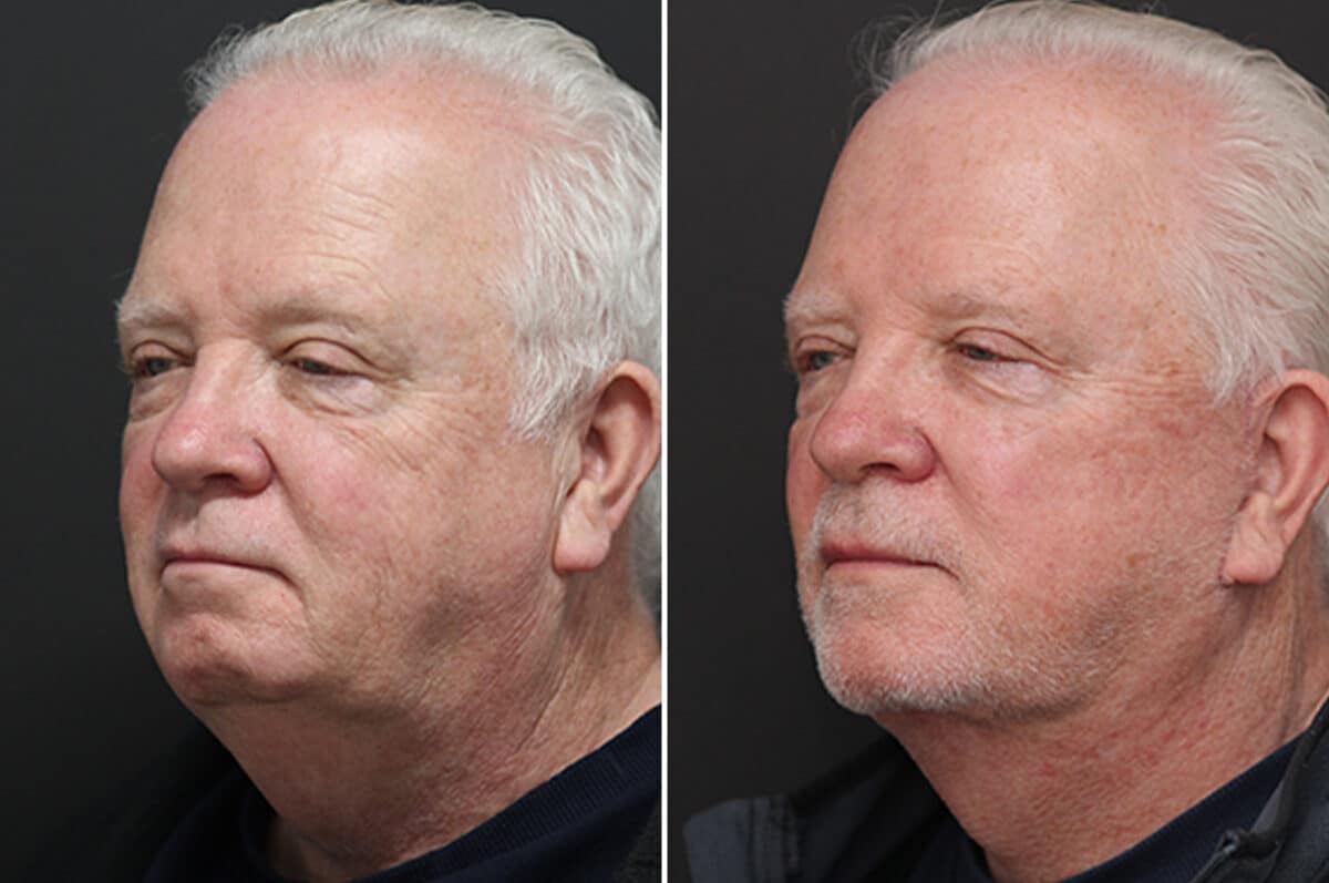 Facelift Before and After Photos in Princeton, NJ, Patient 10975