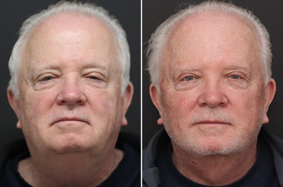 Facelift Before and After Photos in Princeton, NJ, Patient 10975