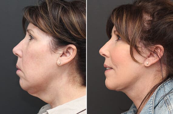 Facelift Before and After Photos in Princeton, NJ, Patient 10976