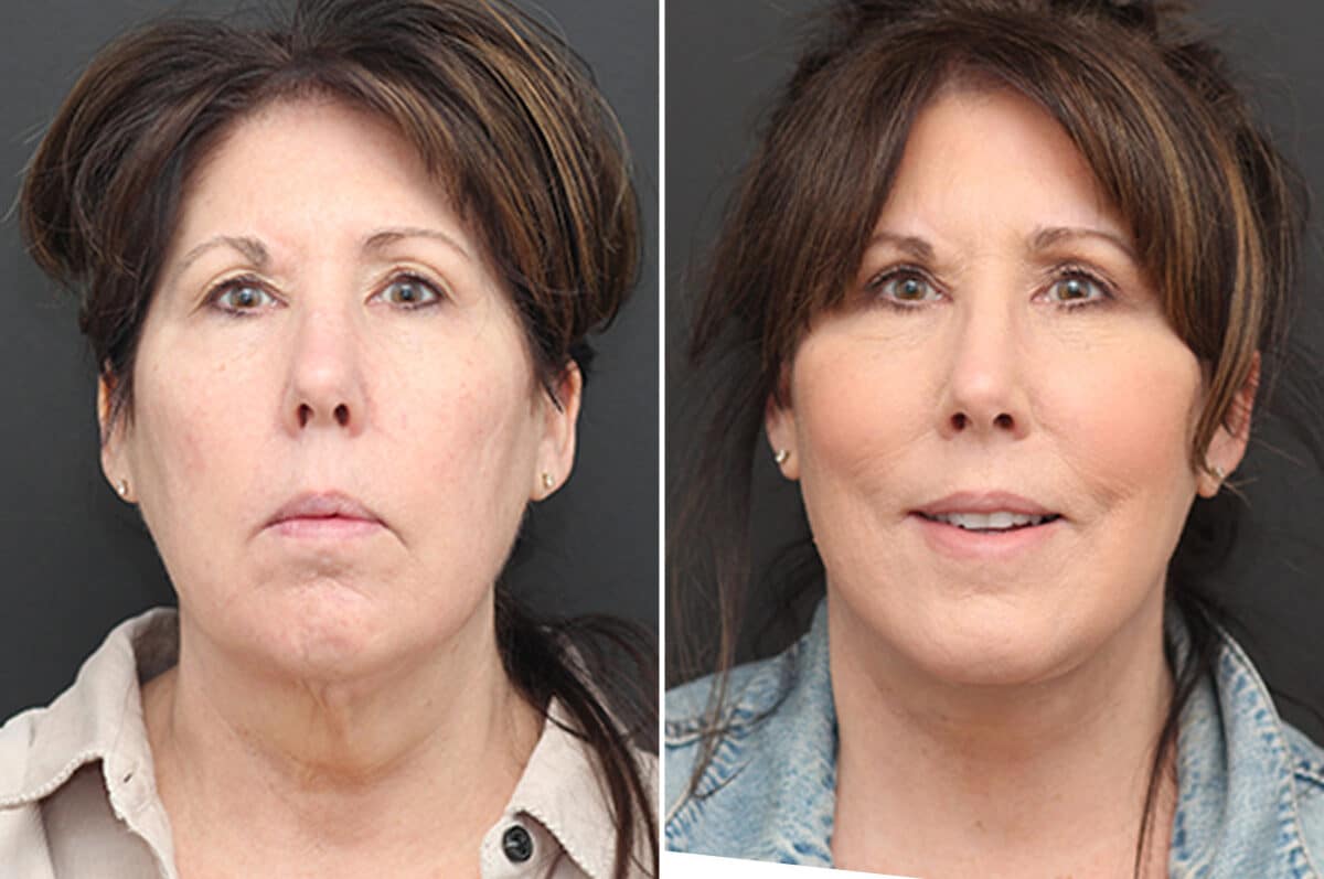 Facelift Before and After Photos in Princeton, NJ, Patient 10976