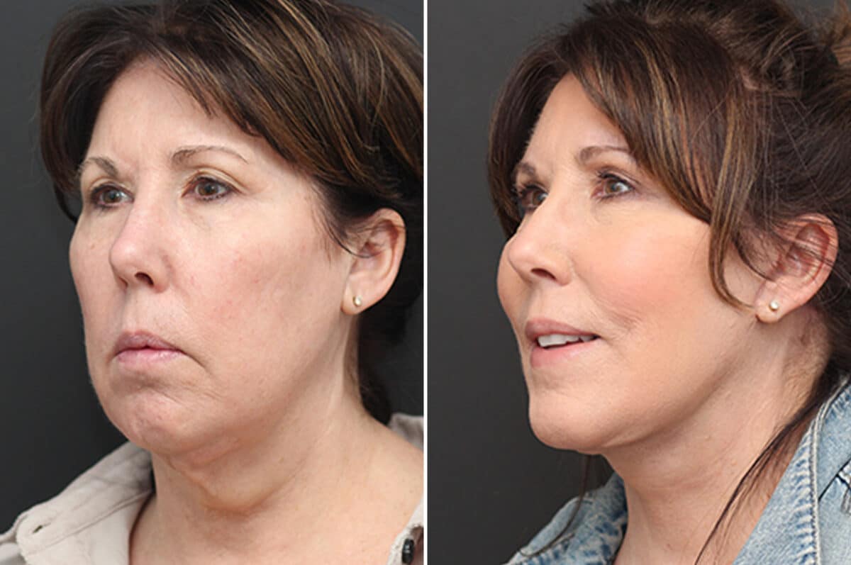 Facelift Before and After Photos in Princeton, NJ, Patient 10976