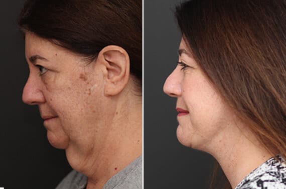 Facelift Before and After Photos in Princeton, NJ, Patient 10977