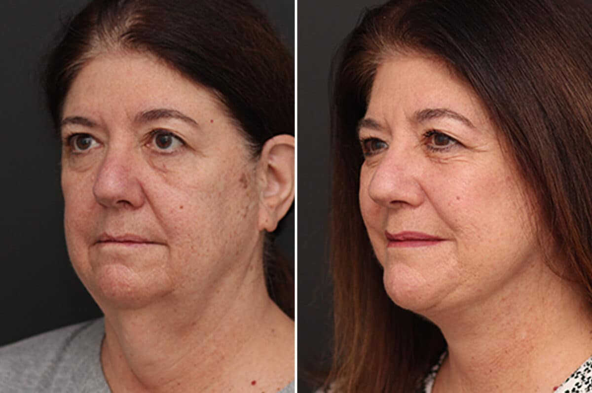Facelift Before and After Photos in Princeton, NJ, Patient 10977