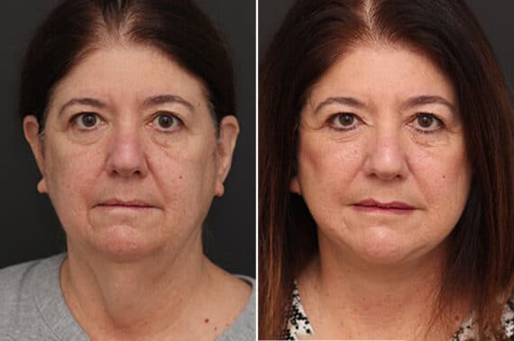 Facelift Before and After Photos in Princeton, NJ, Patient 10977