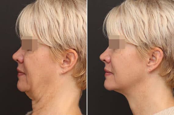 Facelift Before and After Photos in Princeton, NJ, Patient 11020