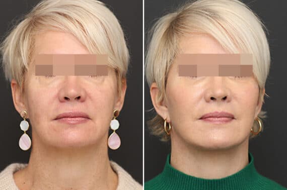 Facelift Before and After Photos in Princeton, NJ, Patient 11020