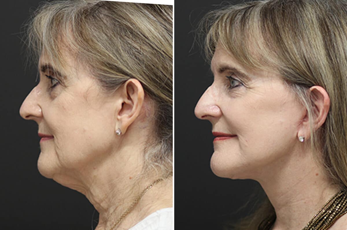 Facelift Before and After Photos in Princeton, NJ, Patient 11021