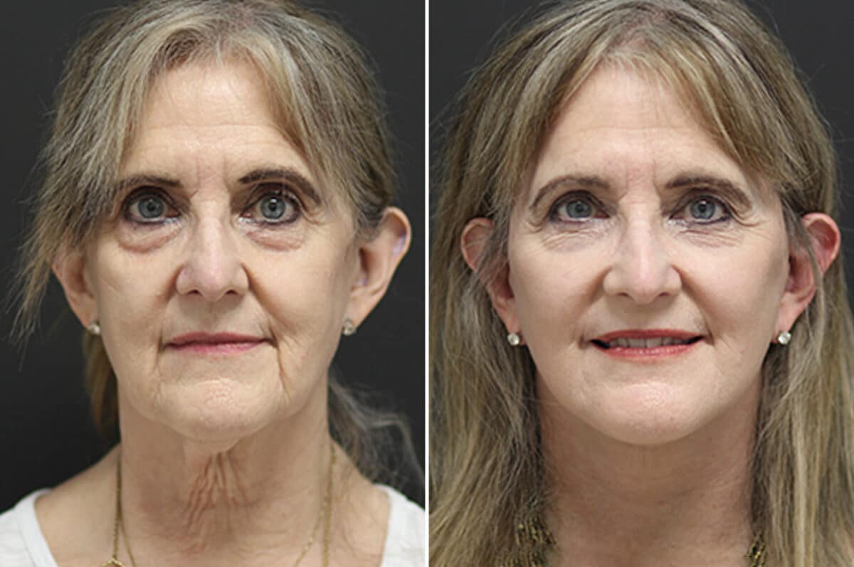 Facelift Before and After Photos in Princeton, NJ, Patient 11021