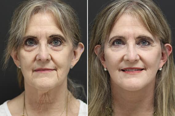 Facelift Before and After Photos in Princeton, NJ, Patient 11021