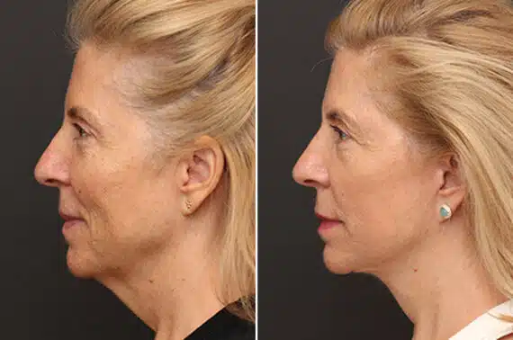 Facelift Before and After Photos in Princeton, NJ, Patient 11022