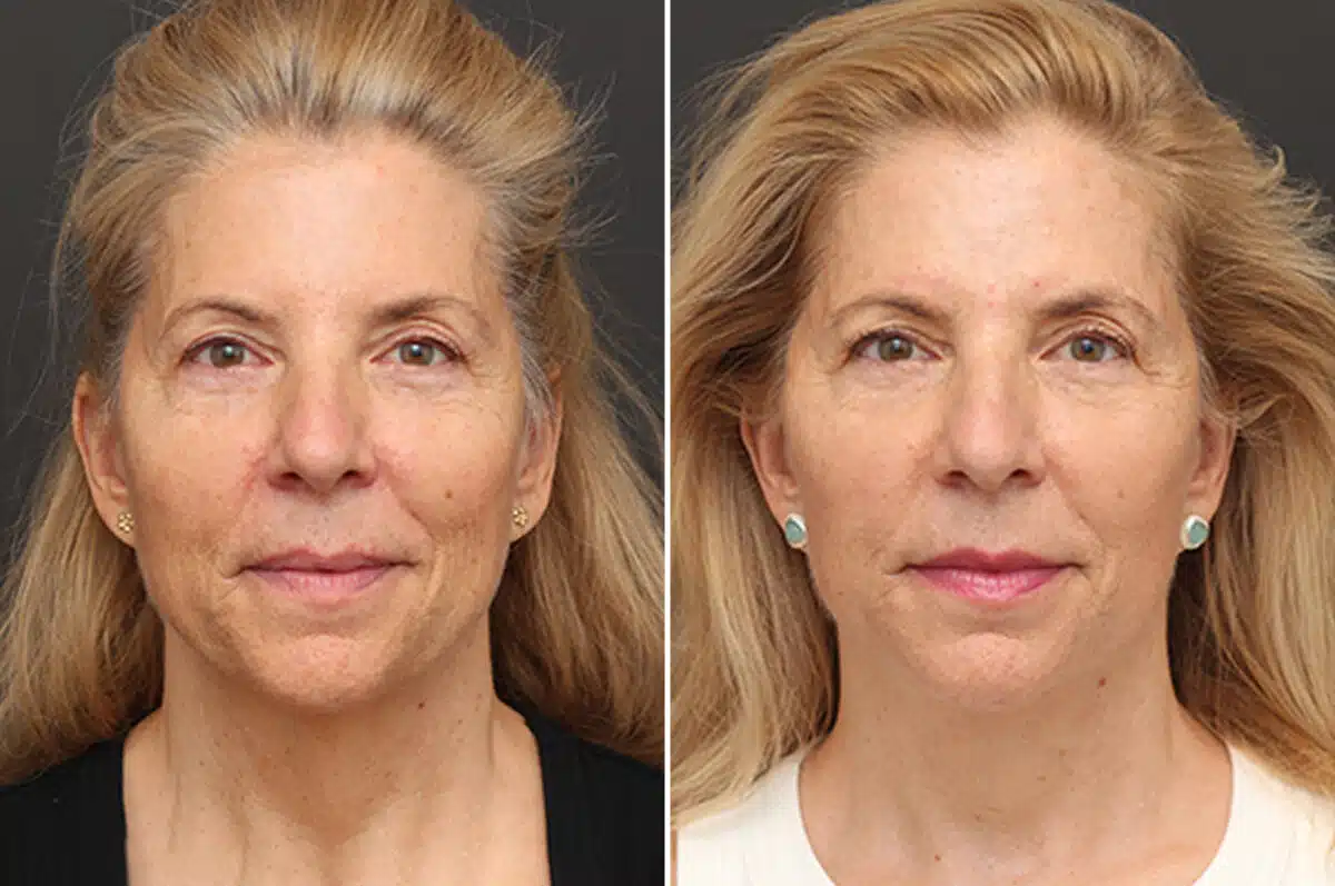 Facelift Before and After Photos in Princeton, NJ, Patient 11022