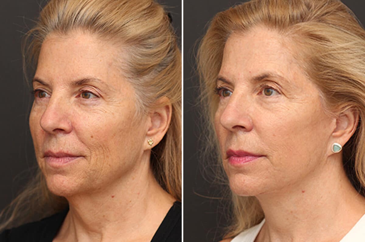 Facelift Before and After Photos in Princeton, NJ, Patient 11022