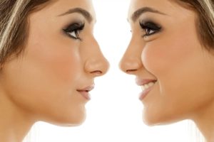 Rhinoplasty can help individuals with enlarged turbinates to restore their breathing by removing the obstruction in the nose