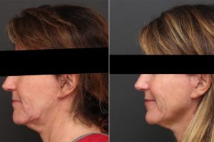 Instalifts can be done in half an hour, without any pain or discomfort. Local anesthesia is used for the procedure and no downtime is needed following it.