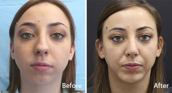 Chin Implants Before and After Photos in Princeton, NJ, Patient 6955
